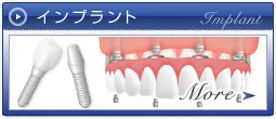 インプラント
