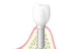 インプラントとは